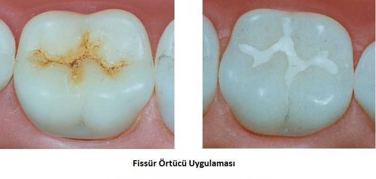 Fissür Örtücüler (Fissur Sealant)